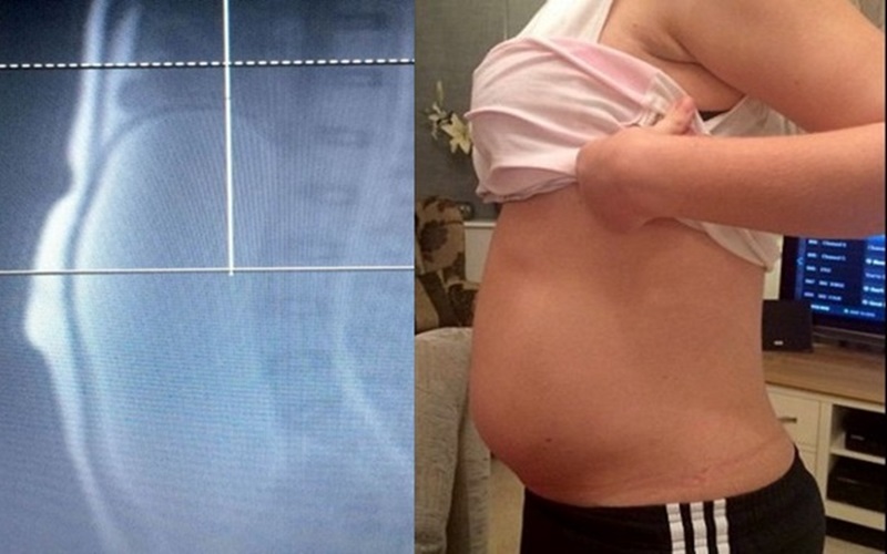 醫生以為這個肚子隆起的女生來找他是因為懷孕，但掃描後竟發現她肚子裡有＆＃8230;.
