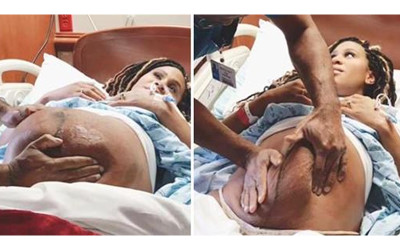 孕婦分娩前發現胎位不正，醫生靠「外轉術」順利轉正，這段神奇畫面曝光後...網驚：神之手
