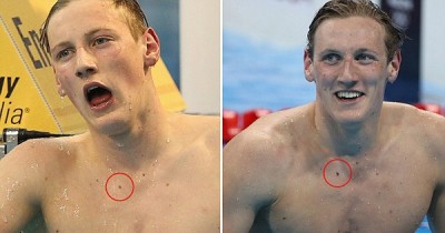 這名奧運冠軍被粉絲提醒「要去檢查胸前的黑痣」檢查後...真的救了他一命！