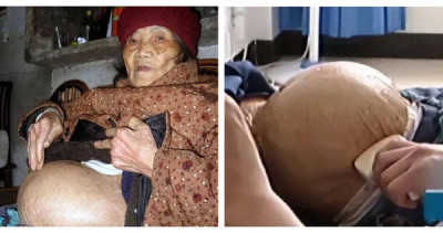 91歲阿嬤跌倒發現「懷孕了」！醫一看驚：是個完整的胎兒
