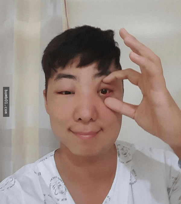 韩国男子因染发过敏导致「整张脸都肿起来」,